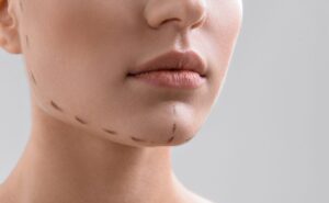 Leia mais sobre o artigo LIPO DE MENTO