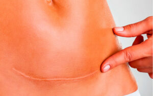 Leia mais sobre o artigo Correção de Cicatriz