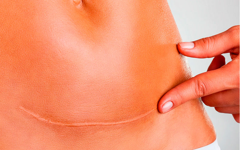 No momento, você está visualizando Correção de Cicatriz