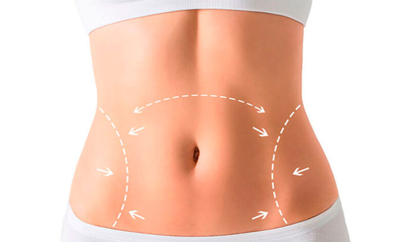 Leia mais sobre o artigo O QUE É A CIRURGIA DE ABDOMINOPLASTIA