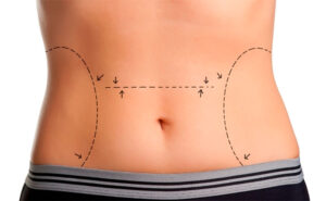 Leia mais sobre o artigo Cuidados essenciais após toda cirurgia plástica