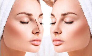 Leia mais sobre o artigo Rinoplastia para corrigir nariz aquilino