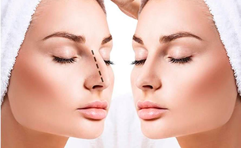 No momento, você está visualizando Rinoplastia para corrigir nariz aquilino