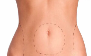 Leia mais sobre o artigo Lipoaspiração reduz gorduras localizadas, mas pode trazer sérios riscos