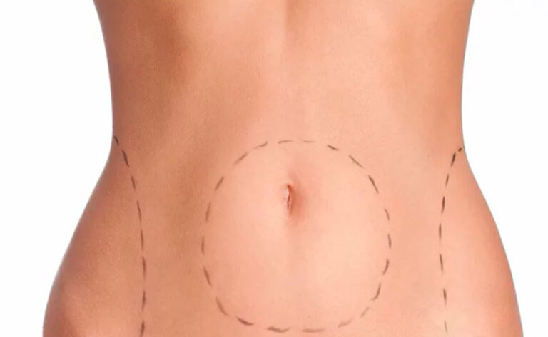 Leia mais sobre o artigo Lipoaspiração reduz gorduras localizadas, mas pode trazer sérios riscos