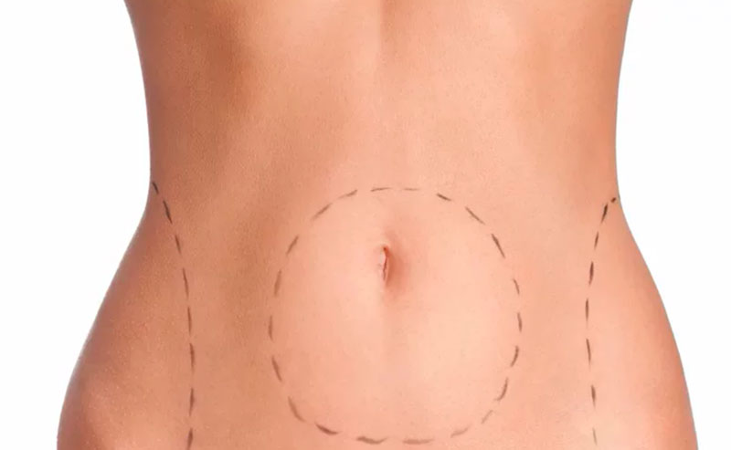 No momento, você está visualizando Lipoaspiração reduz gorduras localizadas, mas pode trazer sérios riscos